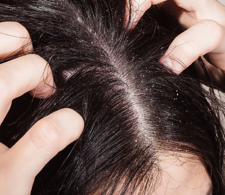 foto model ketombe dan rambut rontok hair scalp care shampoo