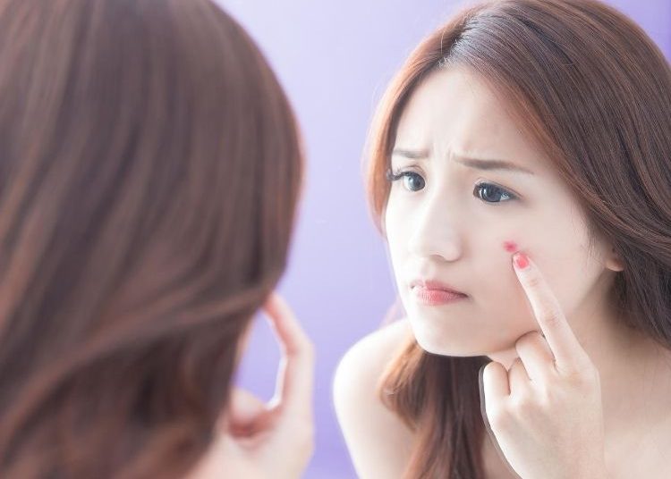 jerawat, memencet jerawat