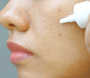 mengatasi jerawat dengan menggunakan acne spot treatment
