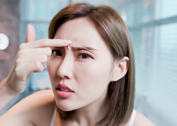 Intip 4 Tips yang Bisa Basmi Jerawat Membandel di Wajah Kamu