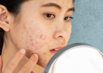 eksfoliasi kulit berjerawat