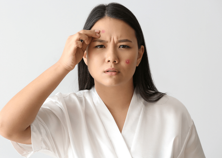 Ketahui 4 Cara Ampuh Mengatasi Kulit Berminyak dan Berjerawat!