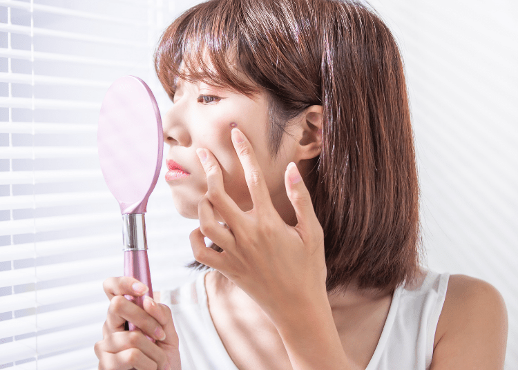 Kenali Bekas Jerawat PIH & PIE Serta Cara Menghilangkannya