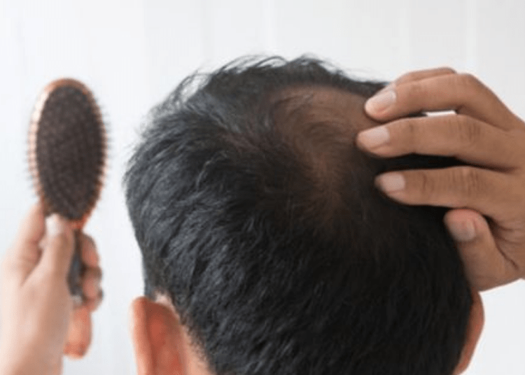 Rambut rontok pada laki-laki