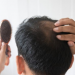 Rambut rontok pada laki-laki