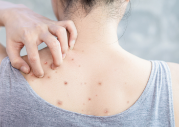 Penyebab Jerawat Punggung dan 2 Produk Ampuh Untuk Mengatasinya, Wajib Coba!