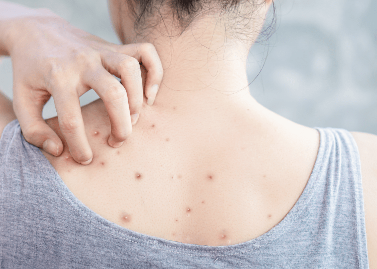 Penyebab Jerawat Punggung dan 2 Produk Ampuh Untuk Mengatasinya, Wajib Coba!