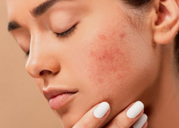 Sabun Muka Jerawat Terbaik