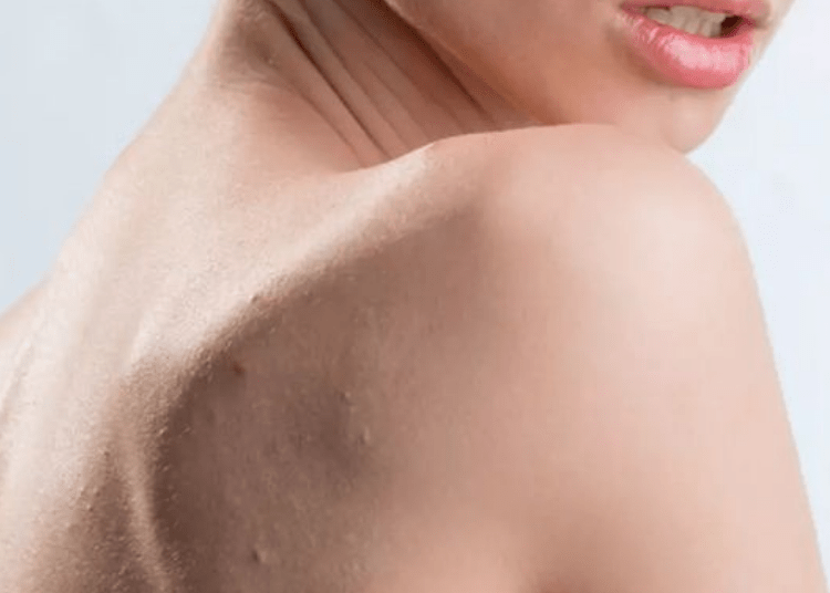 Punya Jerawat Badan? Ketahui Penyebabnya dan Atasi Dengan ERHA