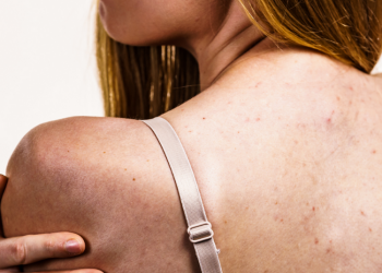 Cepat Basmi Jerawat Punggung Dengan Produk Satu Ini! Wajib Punya!