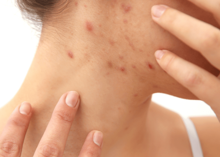 Jerawatan di leher