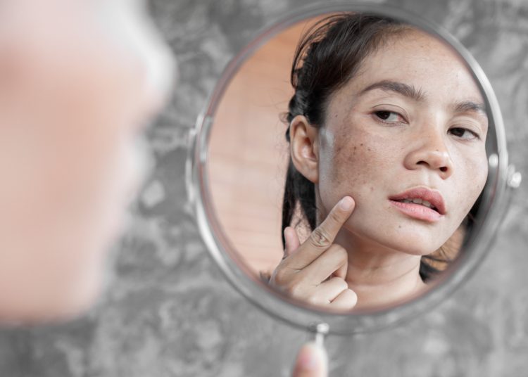 Wajib Tahu 4 Cara Menghilangkan Flek Hitam pada Wajah Tanpa Mahal!