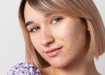 3 Cara Menghilangkan Bekas Jerawat Pada Wajah Secara Alami