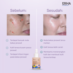 Acne spot serum
