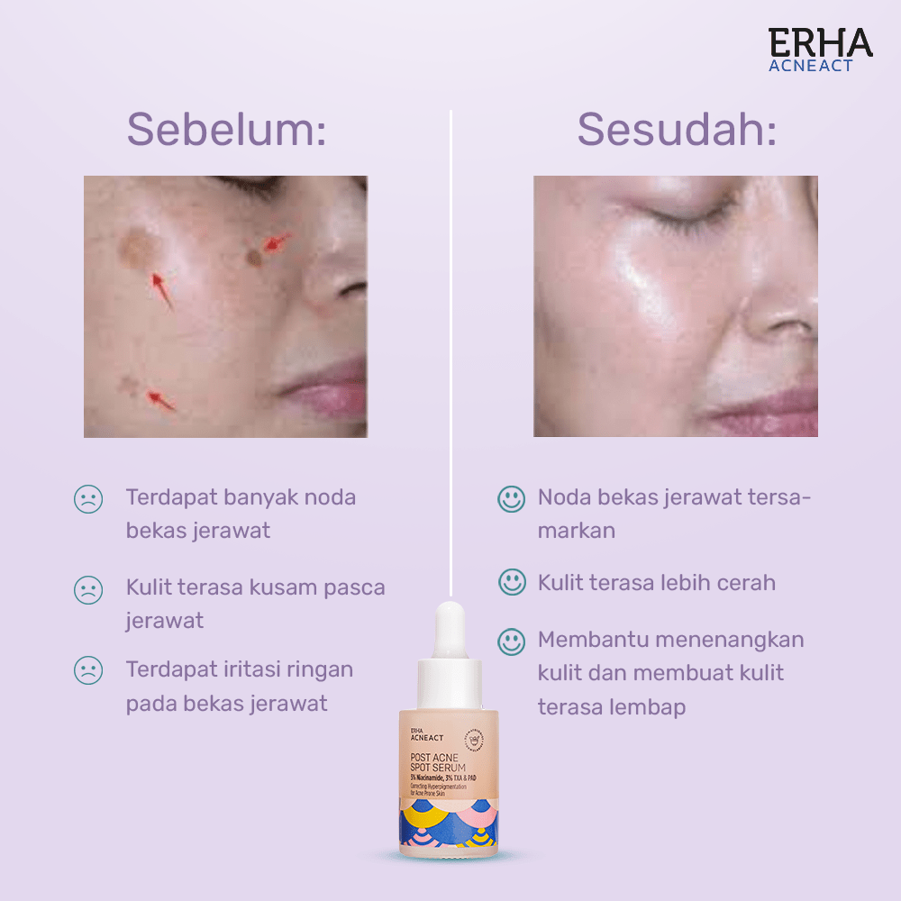 Kenapa Jerawat Susah Hilang Padahal Sudah Pakai Skincare