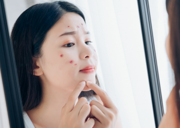 Kenapa jerawat susah hilang