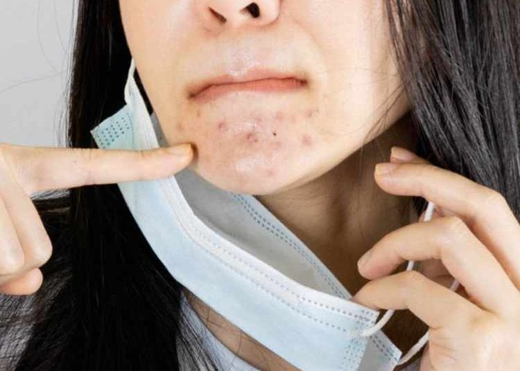 maskne