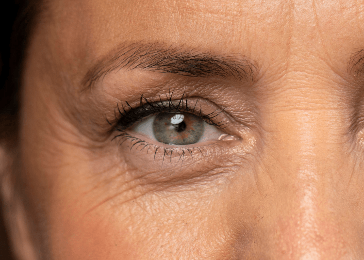4 Penyebab Kemunculan Kerutan Garis Mata dan Produk Ampuh Mengatasinya