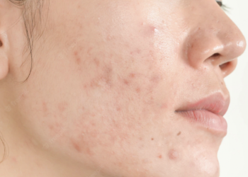Jenis Jerawat Ada Apa Aja? Yuk Cari Tahu!