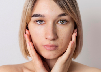 wanita dengan bekas jerawat di wajah