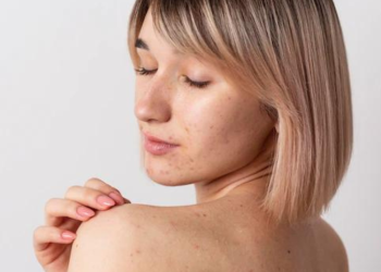 Jerawat Punggung Bikin gak percaya diri? yuk simak mengatasinya