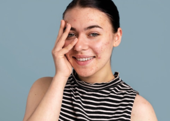 Punya masalah breakout? simak solusinya