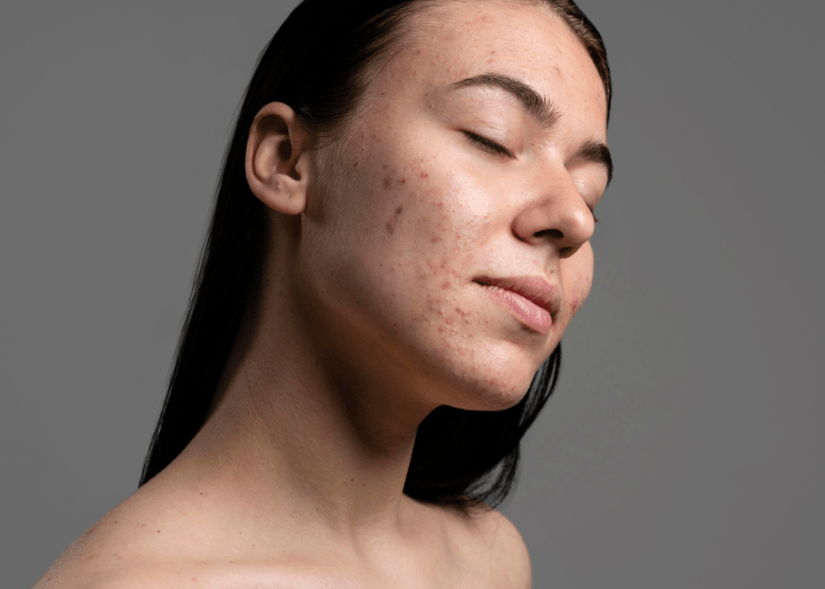 wanita dengan wajah bruntusan