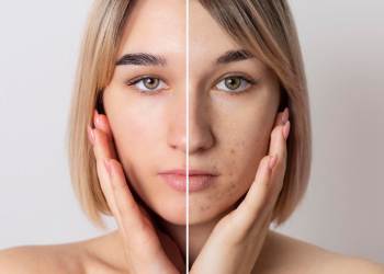 cara menghilangkan dark spot