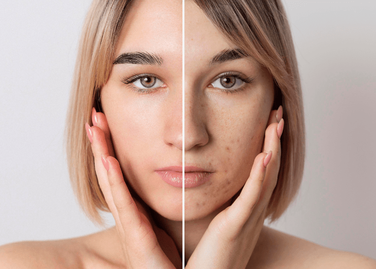 cara menghilangkan dark spot