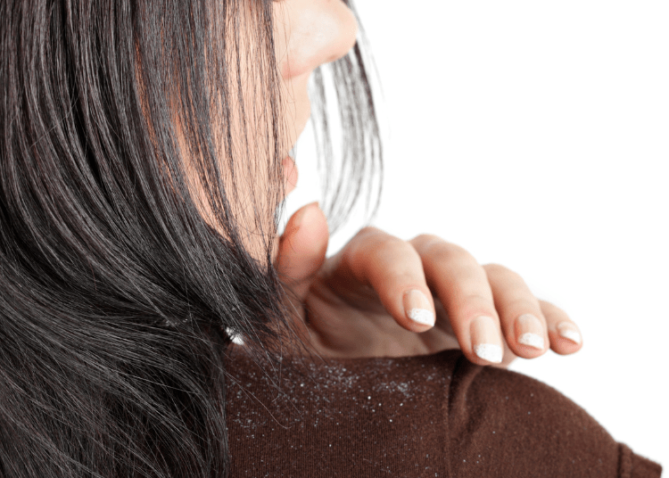 masker rambut ketombe
