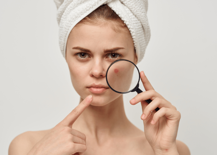 wanita dengan jerawat mendem