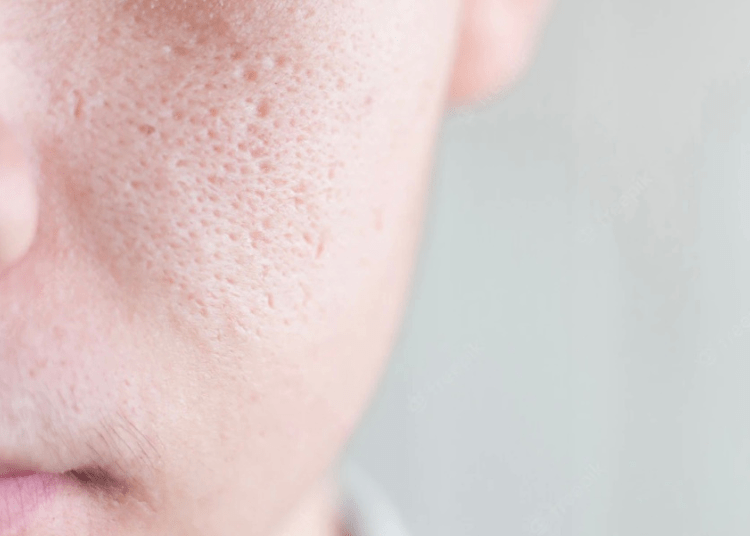 pori-pori wajah besar