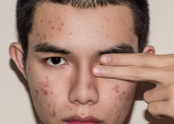 wajah jerawat pria