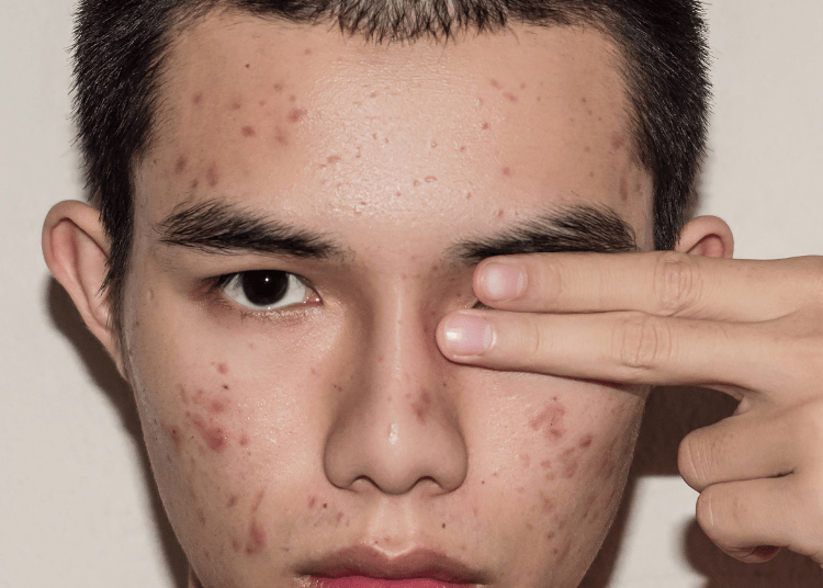 wajah jerawat pria
