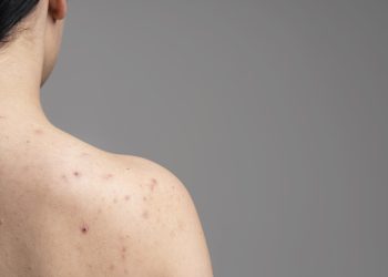 Harus Tahu! Ini 4 Penyebab Jerawat di Punggung