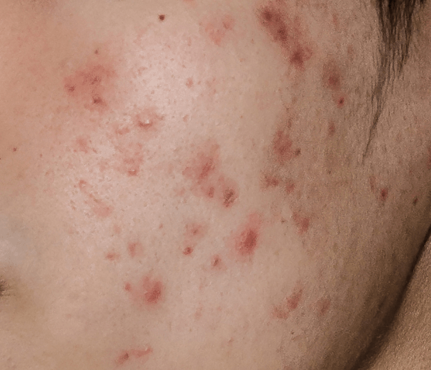 eksfoliasi kulit berjerawat