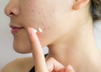 sunscreen untuk kulit jerawat