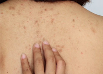 cara menghilangkan jerawat punggung