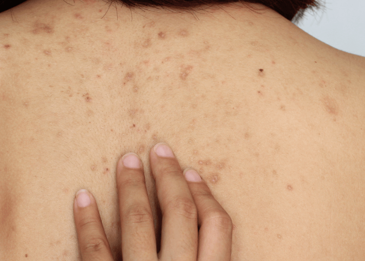 cara menghilangkan jerawat punggung