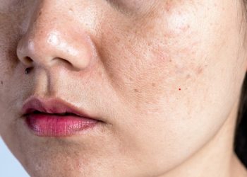 Cara Menghilangkan Flek Hitam di Wajah