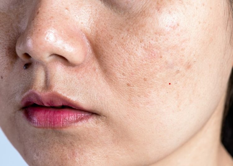 Mau Tahu Cara Menghilangkan Flek Hitam di Wajah yang Membandel? Yuk