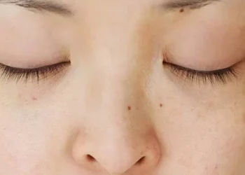 menghilangkan flek hitam