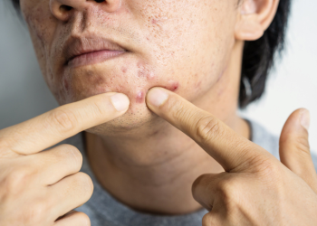 Sabun cuci muka untuk cowo berjerawat