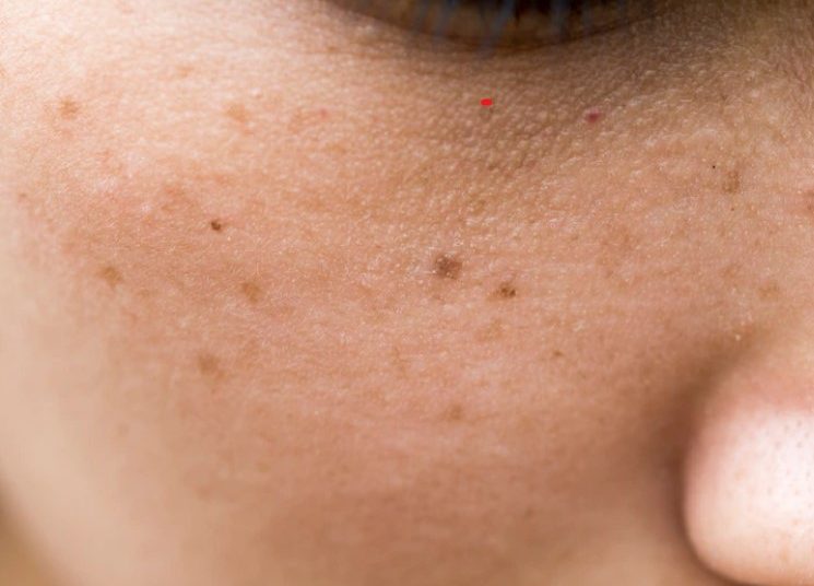 3 Penyebab Flek Hitam dan Cara Mengatasinya yang Wajib Kamu Tahu!