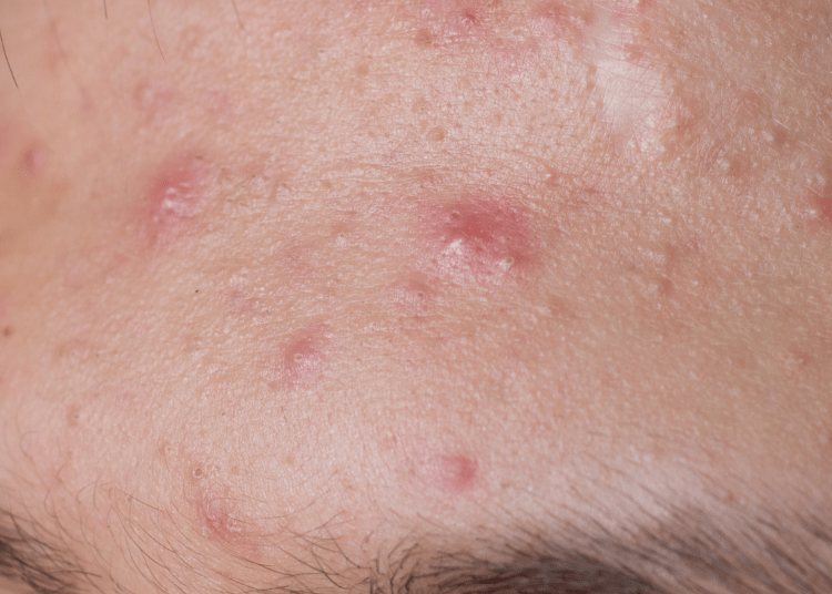 acne skin