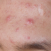 acne skin