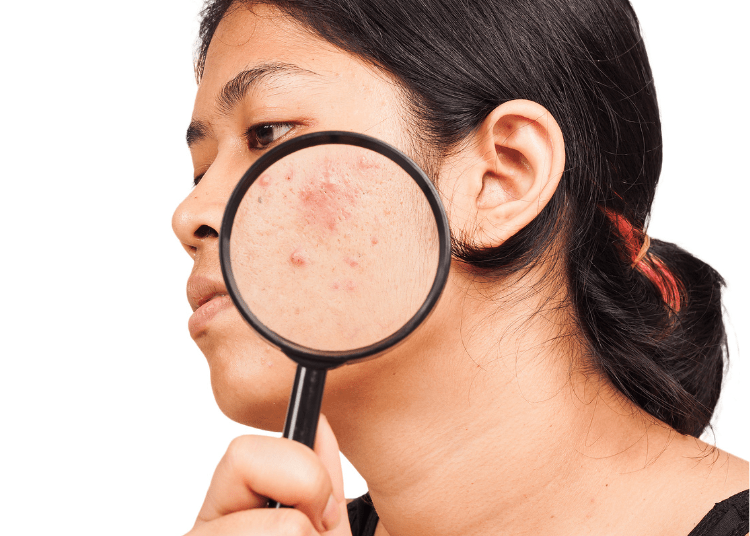 Salicylic Acid