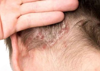 Tips Ampuh Atasi Ketombe & Dermatitis Seboroik