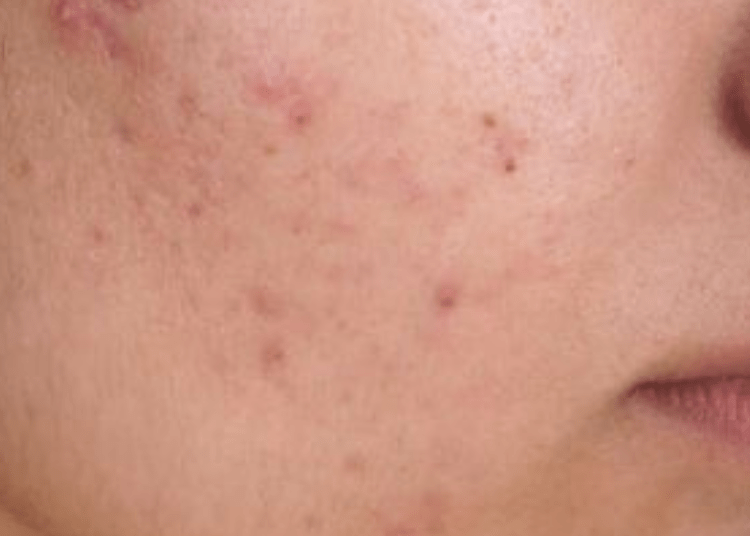 eksfoliasi kulit berjerawat