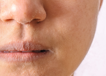 Mengatasi Kulit Kering